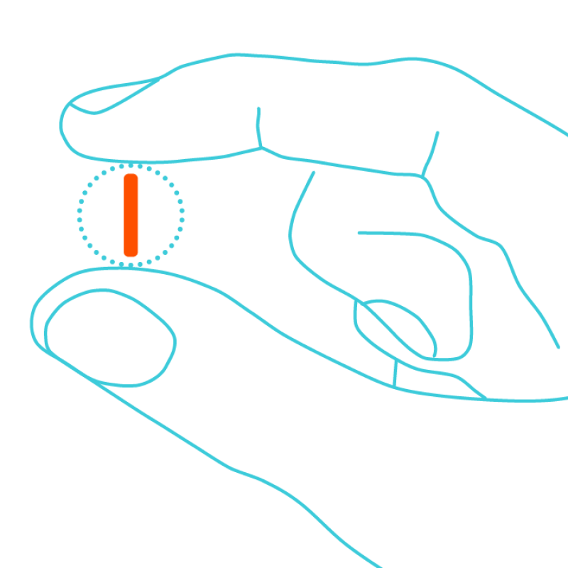 Schematic illustration of a hand with an AMW implant